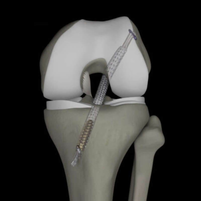 jewel-acl-4